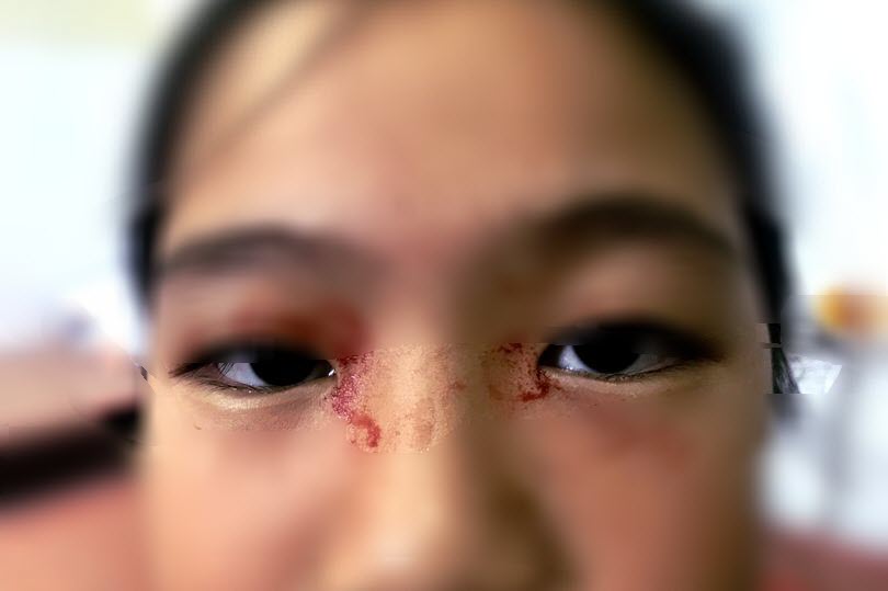 Bé gái 11 tuổi toát mồ hôi như máu ở Việt Nam - 1