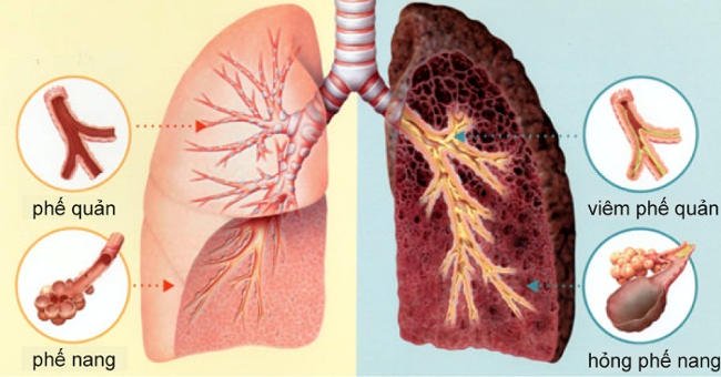 Dấu hiệu nhận biết sớm ung thư phổi