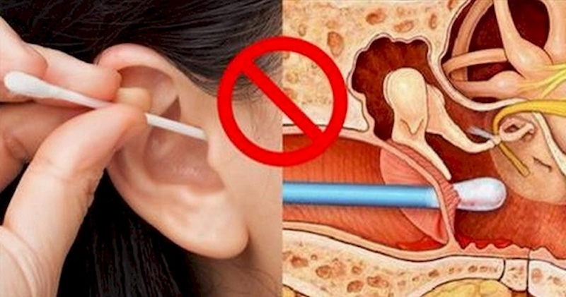 Việc lấy ráy tai không cẩn thận có thể gây thủng màng nhĩ