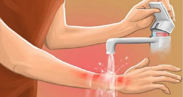 Cẩm nang sơ cứu nhanh 7 tai nạn có thể xảy ra tại nhà