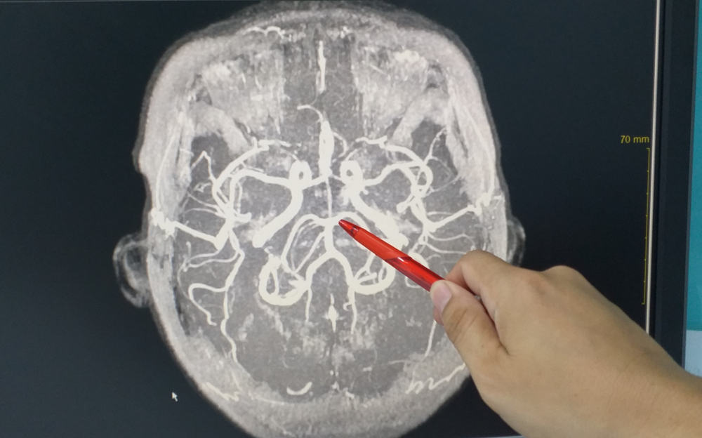 Khi nào thì đau đầu là triệu chứng khối u não?